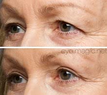 Eye Magic Original Eye Lift Kit (Small/Medium Size With Gel) Lifts Eyelid Droop and Hooded Eyes | Open And Show Off Your Beautiful Eyes | Made In America