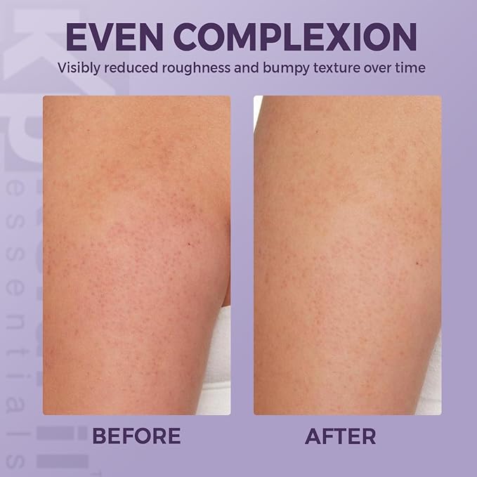 KP Exfoliating Body Treatment with 10% AHA – Non-Gritty Cream Formula with Glycolic & Lactic Acids for Smoother-Looking Skin, Made in USA – 4 oz