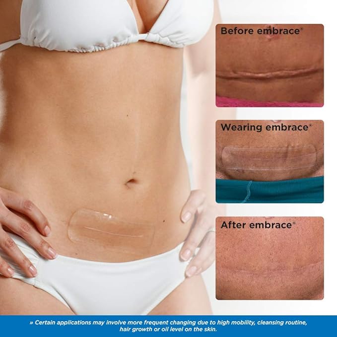 Embrace Active Scar Defense for New Scars, FDA-Cleared Medical-Grade Silicone Scar Sheets for Hypertrophic & Keloid Scar Treatment, 4.7 Inch, Large, 30-Day Supply