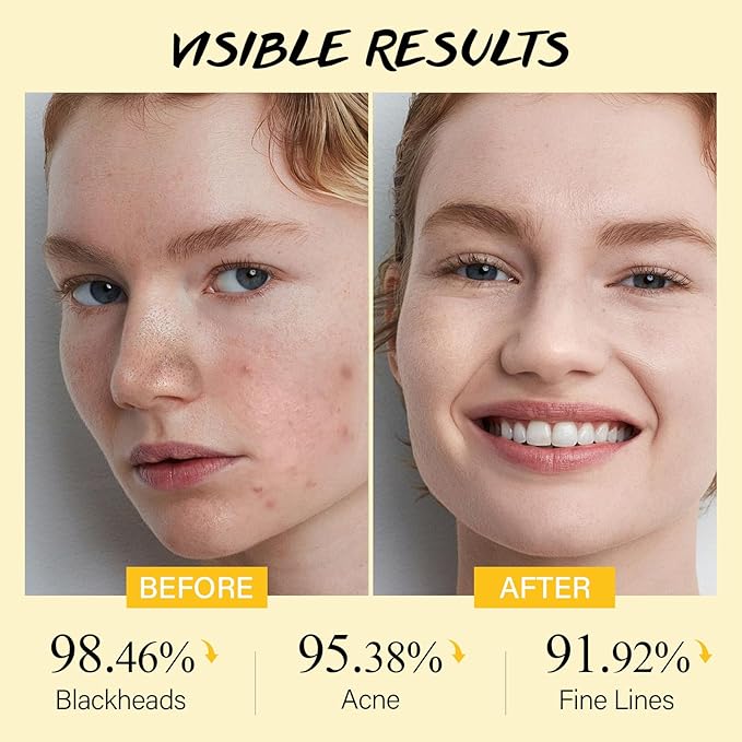 Lemon Face Scrub with Glycolic Acid Microdermabrasion Facial Scrub AHA Exfoliating for Women Men Safe Vegan Improves Acne Blackheads Soft Soothing without Irritation