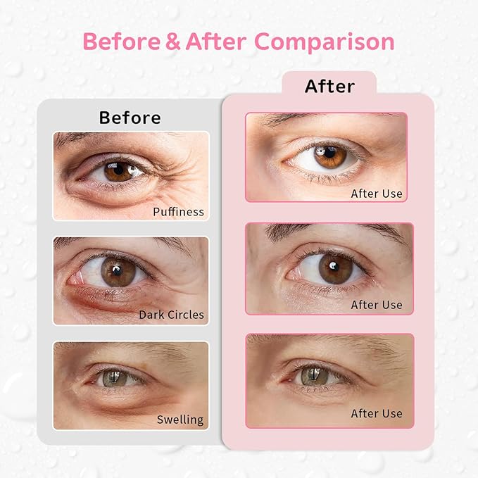 Gel Ice Pack Reusable Cooling Eye Pads and Under Patches,Eye Hot Cold Treatment for Redness,Pain Relief Relax (Butterflies)