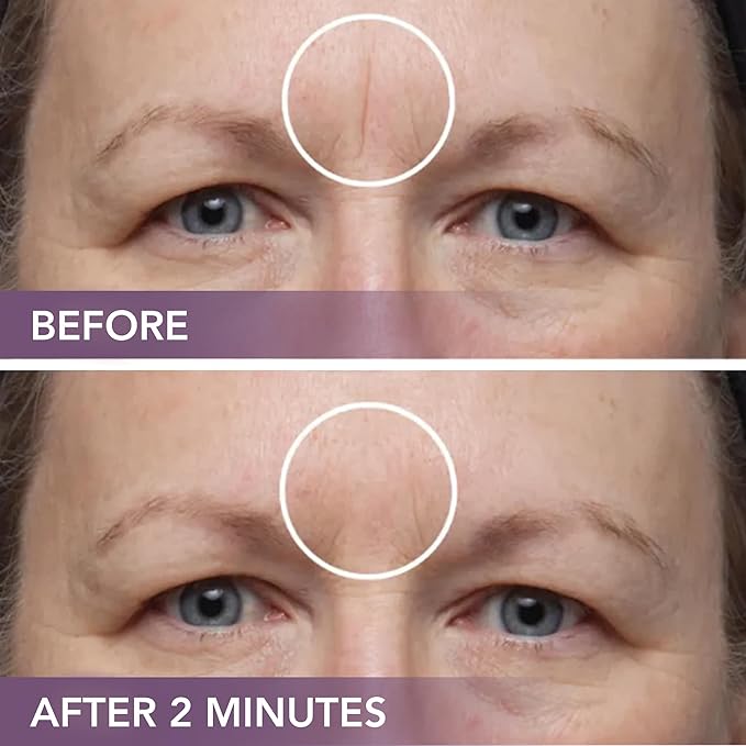 Dermaflage Scar Filler Kit - Deep - Deep Scar Cover and Waterproof Concealer for Acne Scars Wrinkles, and Ice Pick Scars Makeup, 1 mo supply