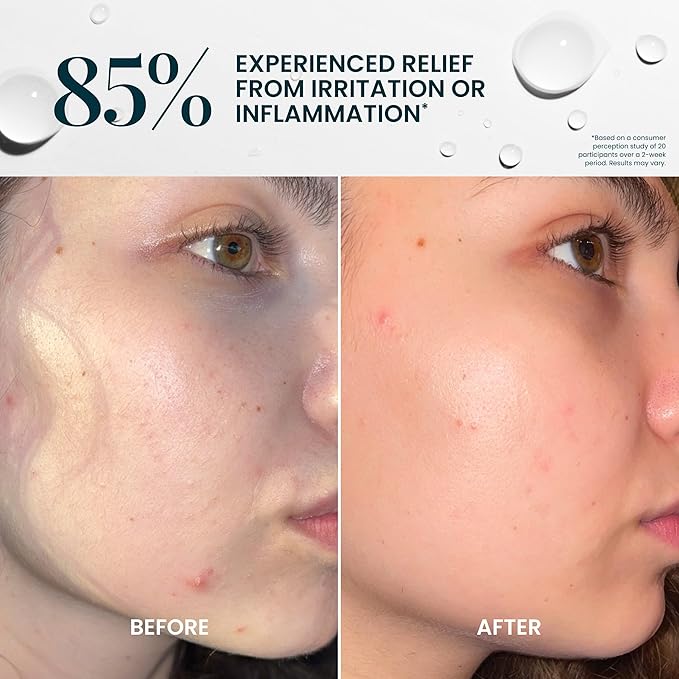 FlutterHabit Hypochlorous Acid Spray, Face Mist for Acne Prone Skin, HOCl Formula to Soothe Irritation, Refresh Complexion, Repair Damage, Balance Oil, Calm Redness, Restore Clarity (125mL)