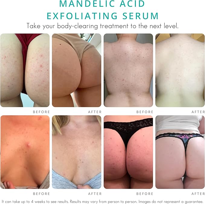 Level 2 Serum | Mandelic Acid Body Serum for Acne, Folliculitis, Aging Skin, Ingrown Hairs, Dark Spots on Face, Chest, Butt, Back, Thighs, Arms | 4 oz