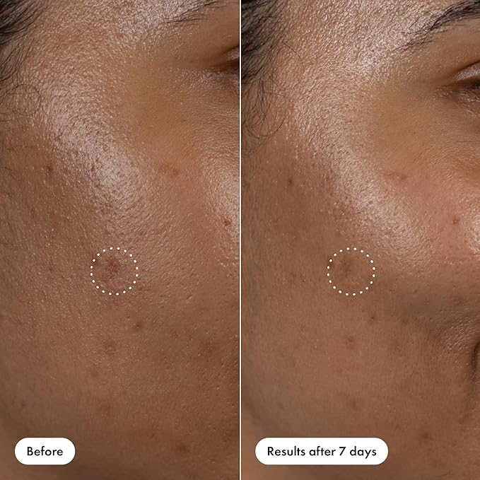 Hero Cosmetics Dark Spot Correct Spot-Fading 15% Vitamin C plus Hyaluronic Acid Serum. Improves the Look of Post Blemish Marks in 7 Days. Twist Applicator and Rollerball Tip for Easy Application. 10mL